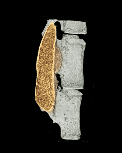 The colored region in a micro-CT image shows regenerated high-quality bone in the spine with minimal use of growth factor.