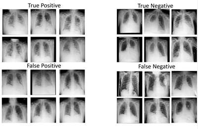 Sample of most representative images from different classes of DeepCOVID-XR predictions relative to the reference standard. Credit: Northwestern University