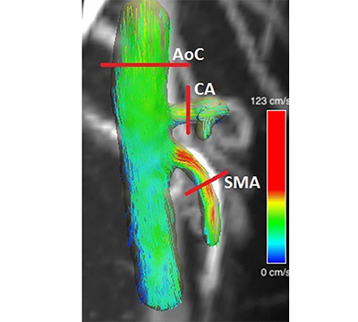Credit: 4D Flow MRI for Assessment of Renal Transplant Dysfunction (Michael Markl)