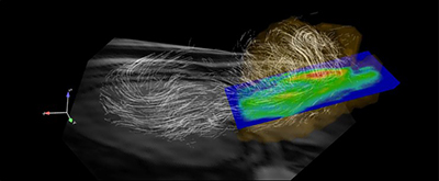 Credit: '4D Flow MRI' for the comprehensive assessment of cardiovascular hemodynamics (Michael Markl)