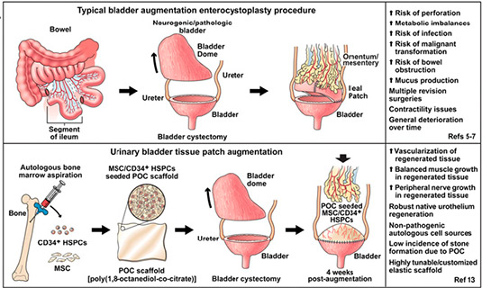 A comparison of a typical bladder augmentation enterocystoplasty procedure and a new method designed by a team of researchers.