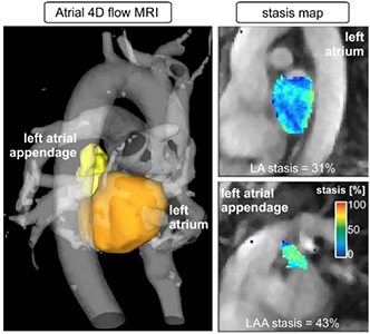4D flow CMR can be employed to measure in-vivo 3D blood flow dynamics in the heart and atria. Derived flow stasis maps in the left atrium and left atrial appendage are a novel concept to visualize and quantify regions with low flow, known to cause clot formation and risk for stroke.