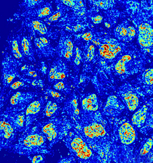 Backman's imaging technique can capture nanoscopic information from dozens of nuclei within seconds, as seen here in cancer cells.