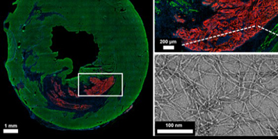 Peptides respond to biochemical signals inside heart tissue (green) following a heart attack, spontaneously forming a gel-like material (red) that could be used for healing. The hydrogel, which can stick to tissue, is made up of nanoscale fibers that tangle together (bottom right).