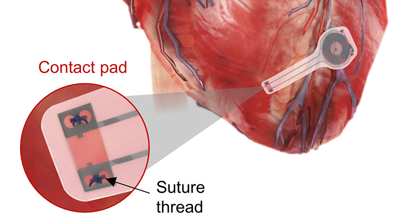 The device, seen here mounted on the heart, could have many benefits for post-cardiac surgery patients.