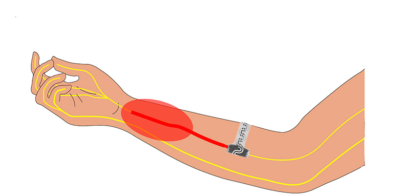 The device works by softly wrapping around nerves to deliver precise, targeted cooling, which numbs nerves and blocks pain signals to the brain. After it is no longer needed, it naturally absorbs into the body.