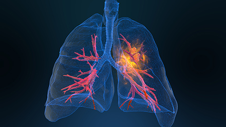 Lung graphic