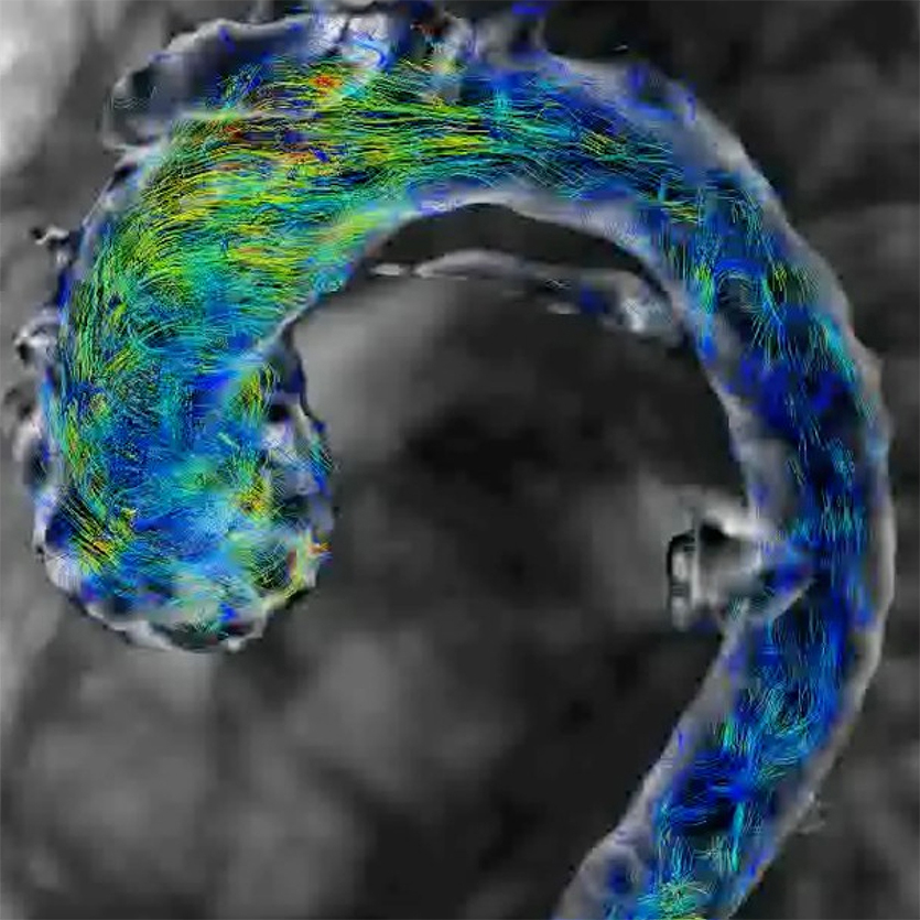 A 4D flow MRI scan of a human aorta. Credit: Ethan Johnson