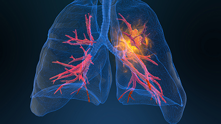 Lung