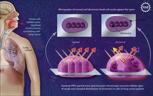 Backman lung cancer diagram