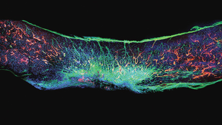 X-ray of scar tissue