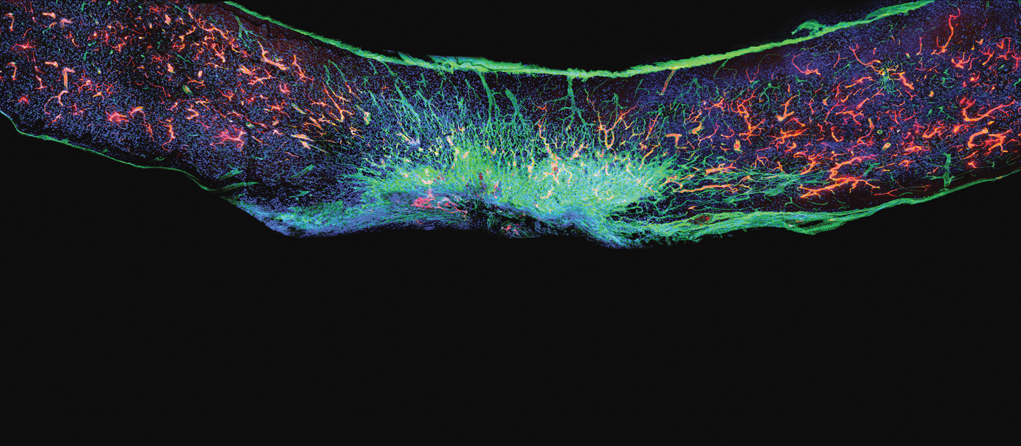 X-ray of scar tissue