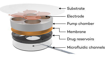 Bioelectronic Implant diagram