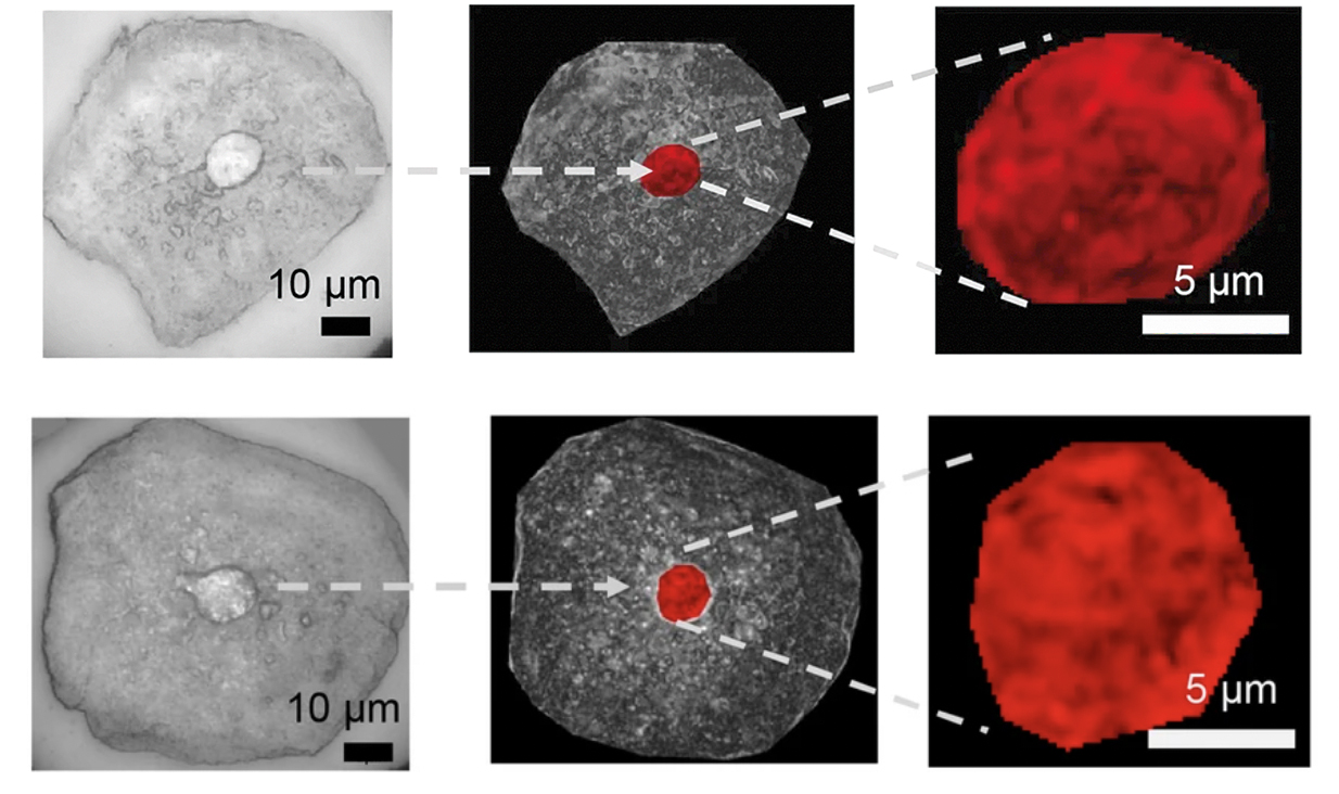 An image of buccal mucosa cells—located in the cheeks and lungs—in a control patient (top) and patient with lung cancer (bottom). The chromatin packing in the cell’s nucleus is highlighted in red.