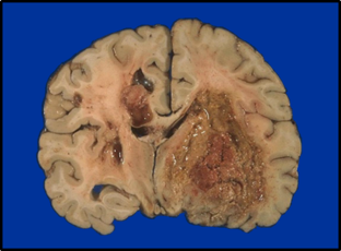 Brain Tumor Therapeutics | Research | Falk Center for ...